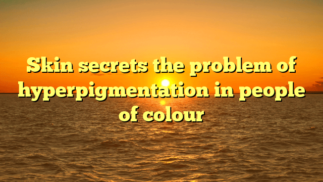 Skin secrets the problem of hyperpigmentation in people of colour